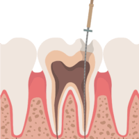 root-canal