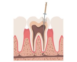 歯の根幹治療