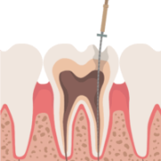 root-canal